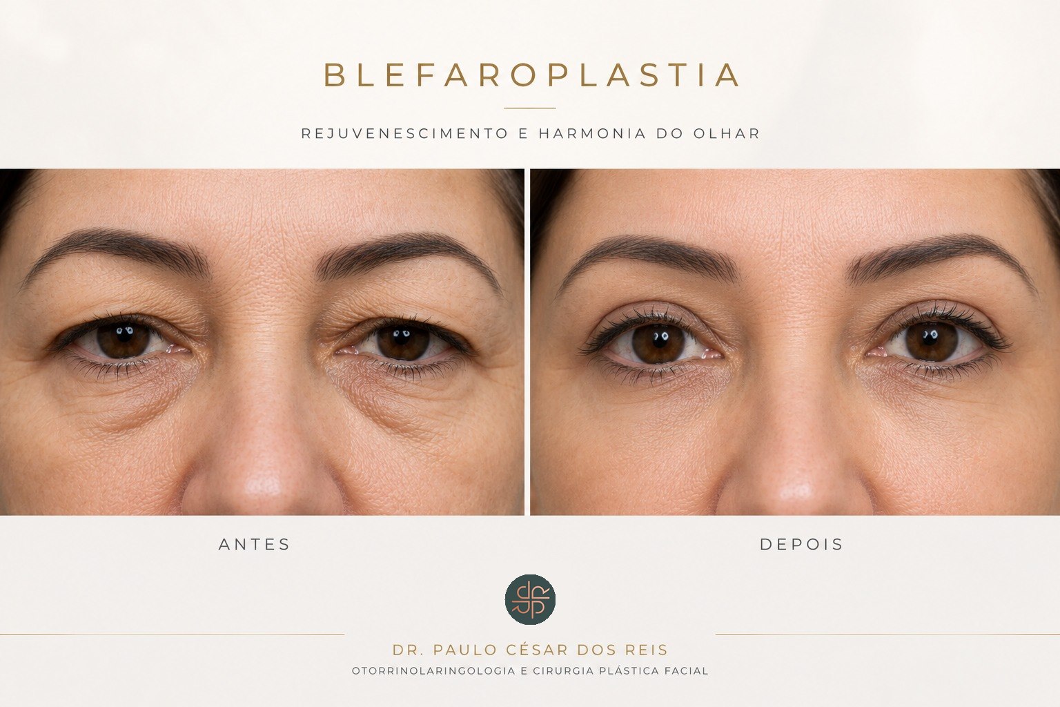 Antes e depois ilustrativo de blefaroplastia — imagem ilustrativa