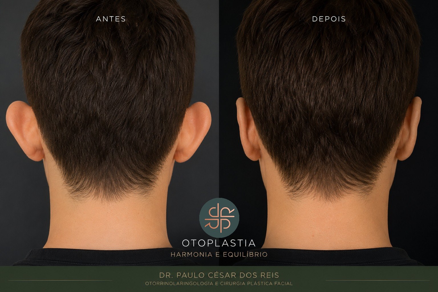 Antes e depois ilustrativo de otoplastia — imagem ilustrativa
