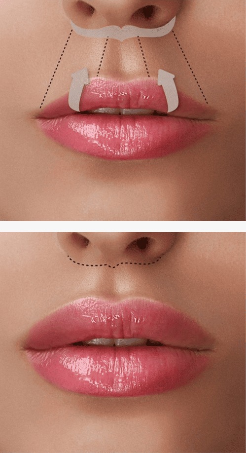 Ilustração da técnica do lip lift — imagem ilustrativa